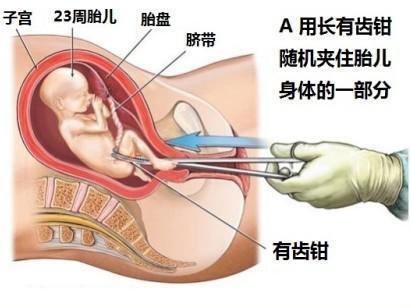 关于三个月无痛人流的全面解析