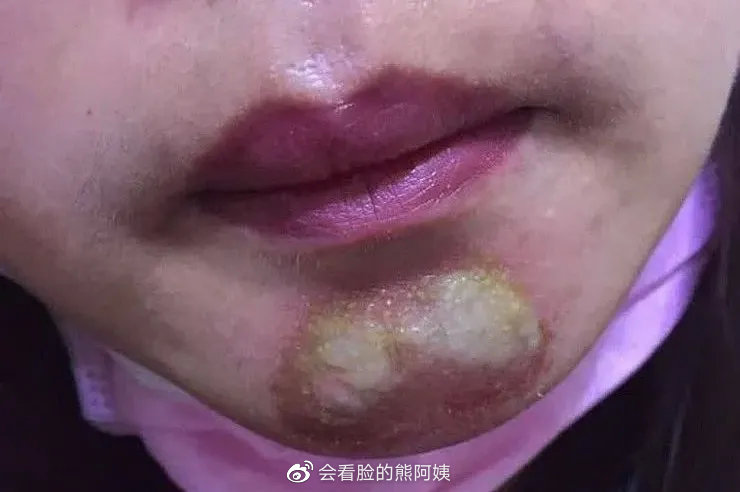 玻尿酸注射数月后突然肿胀现象解析